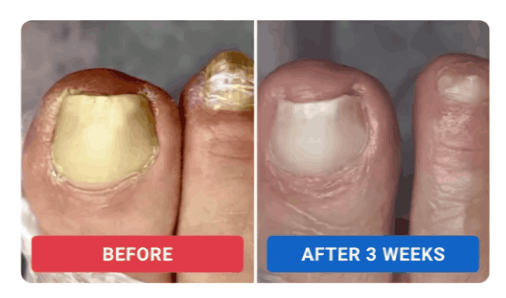 Orivelle Anti-Fungal Pen customer -Tahira S. Texas, USA